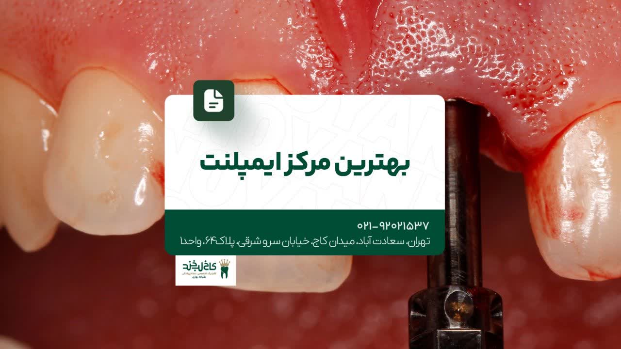 بهترین مرکز ایمپلنت بهترین مرکز ایمپلنت