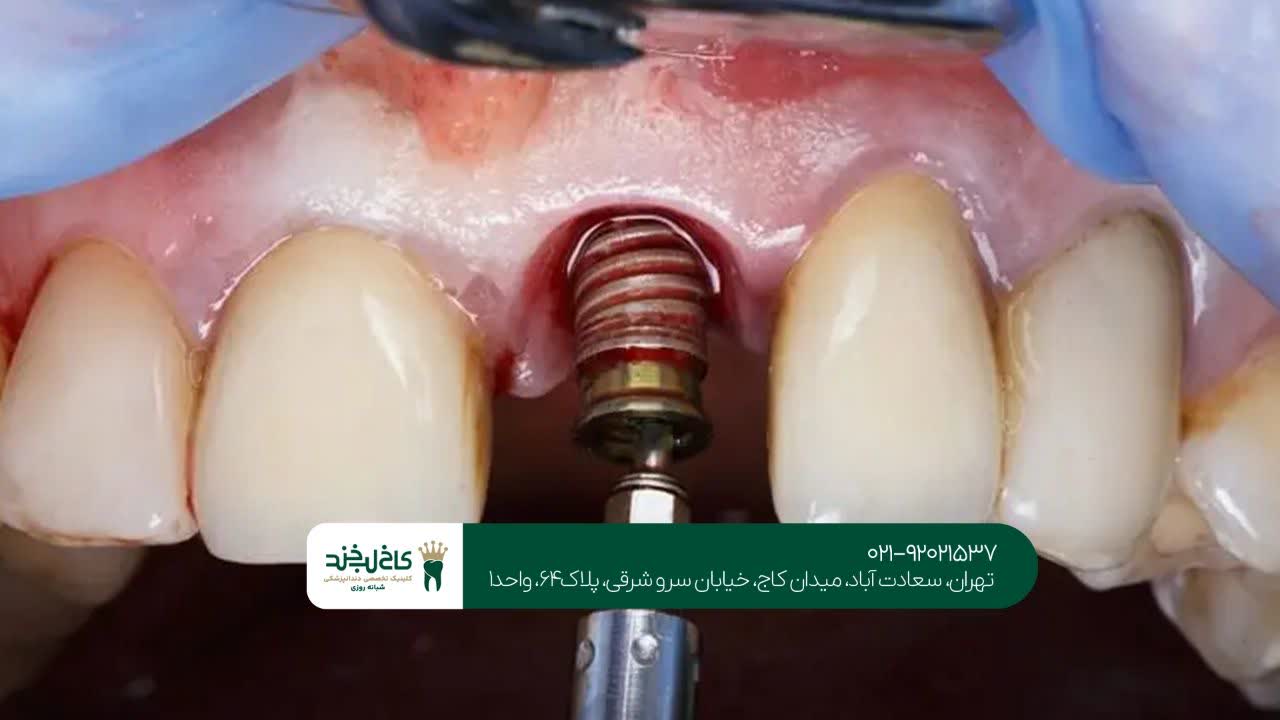 مرکز ایمپلنت در تهران مرکز ایمپلنت در تهران