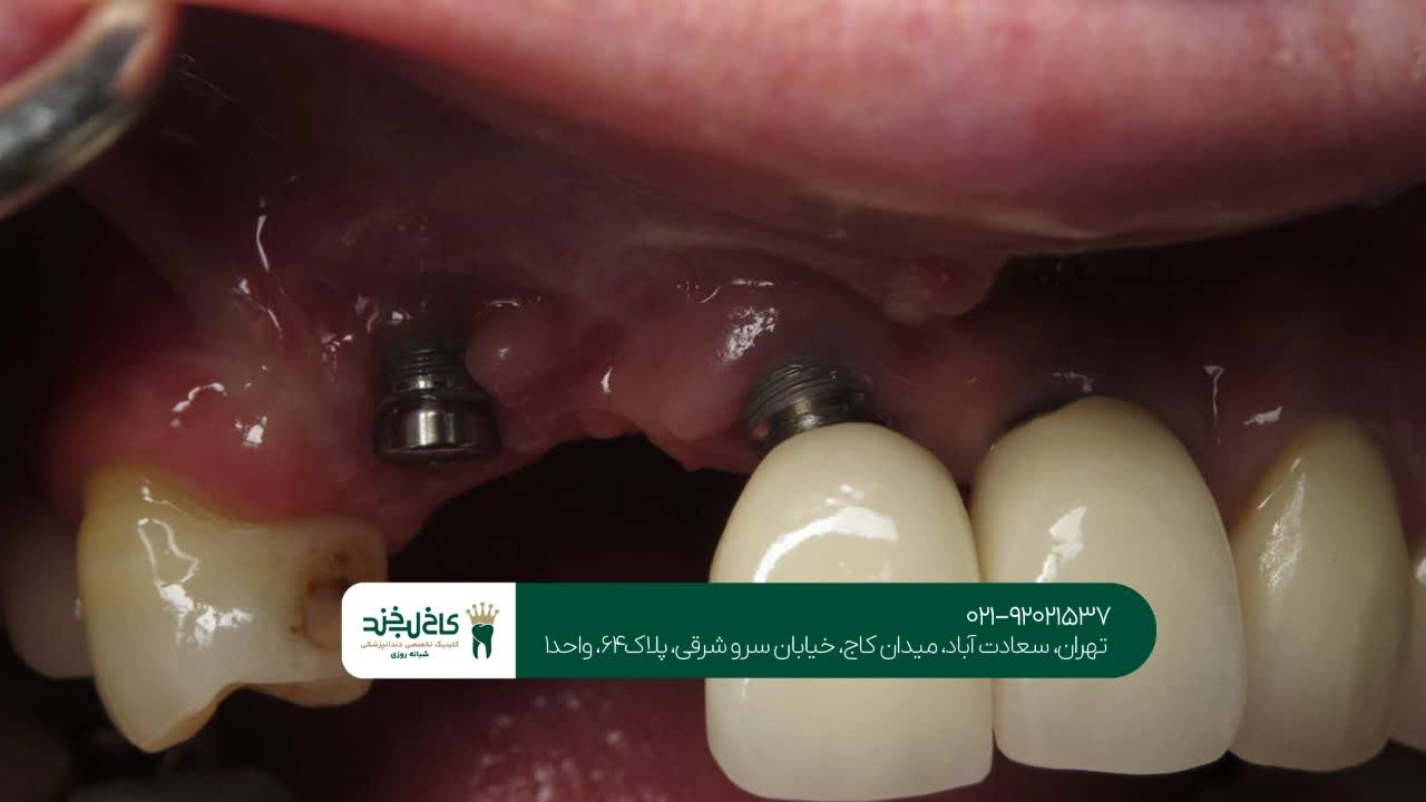 دندانپزشکی ایمپلنت تهران دندانپزشکی ایمپلنت تهران