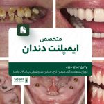 متخصص ایمپلنت تهران