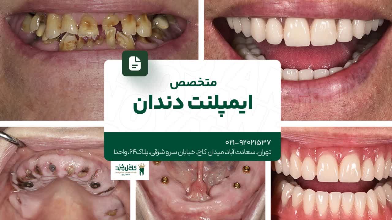 متخصص ایمپلنت تهران متخصص ایمپلنت تهران