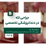 جراحی لثه در دندانپزشکی تخصصی