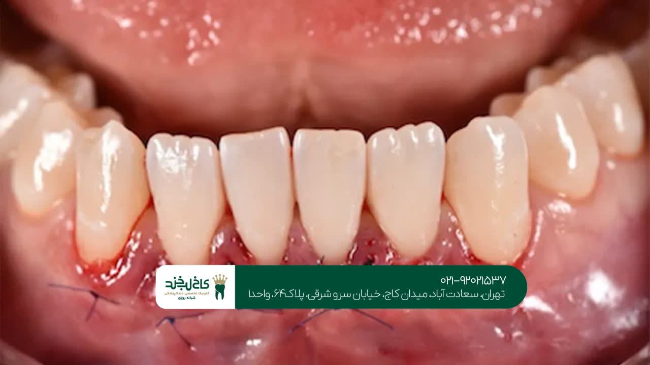 تفاوت جراحی لثه با درمانهای معمولی لثه