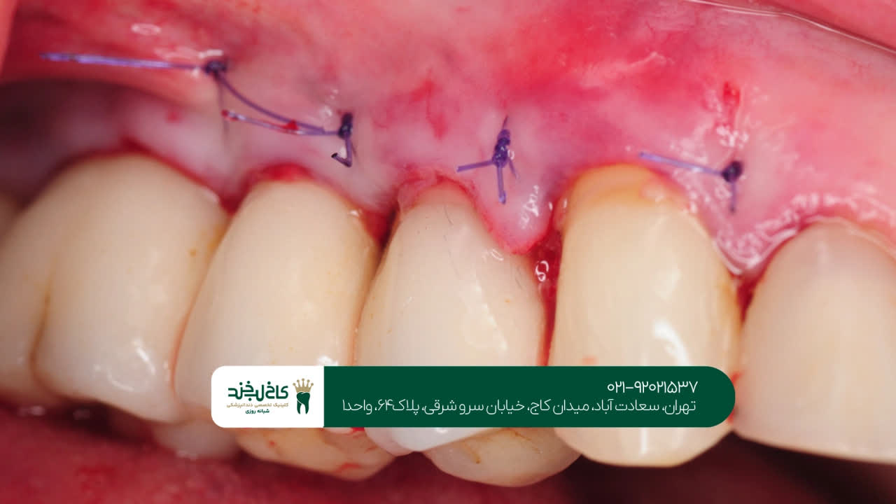 مراحل انجام جراحی لثه در کلینیک