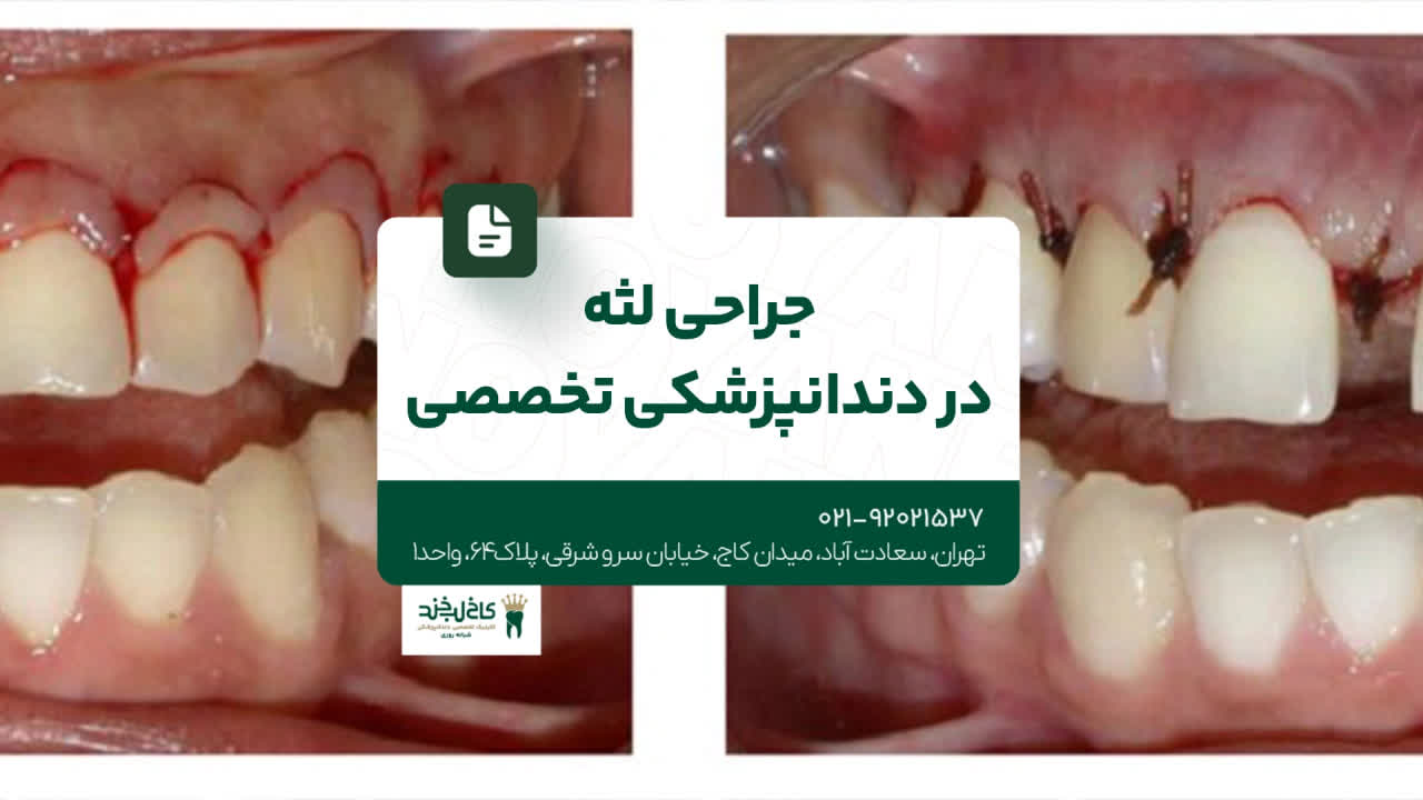 جراحی لثه در دندانپزشکی تخصصی