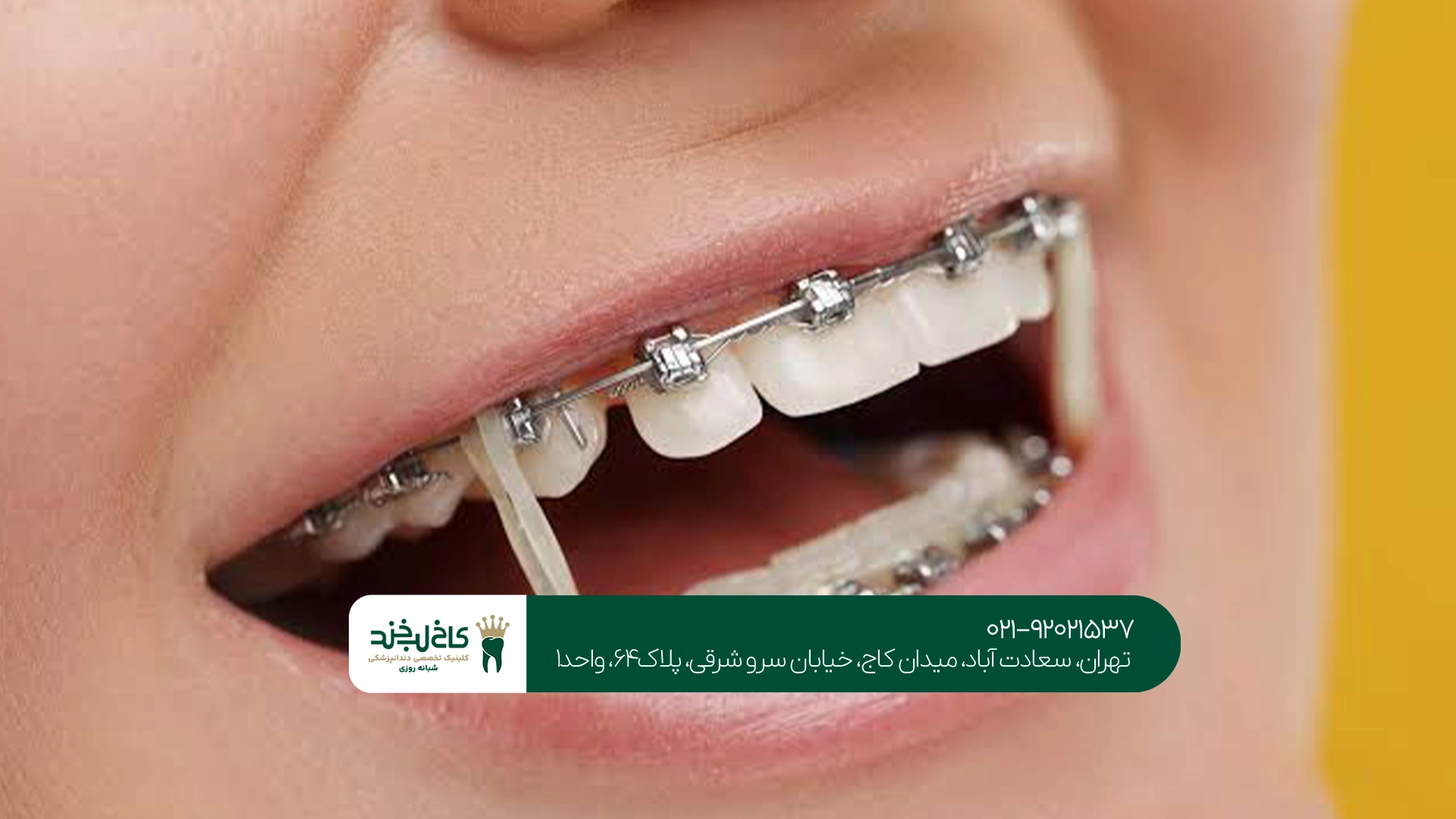 درمان ارتودنسی با حداقل درد