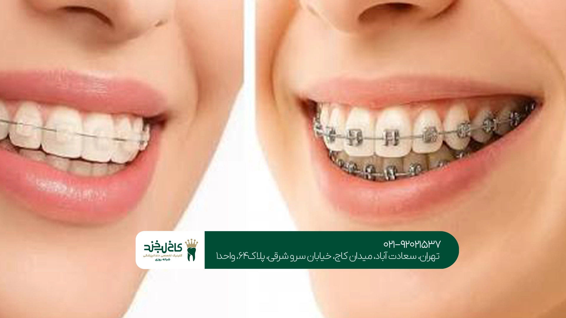 علت درد دندانها بعد از شروع ارتودنسی چیست؟