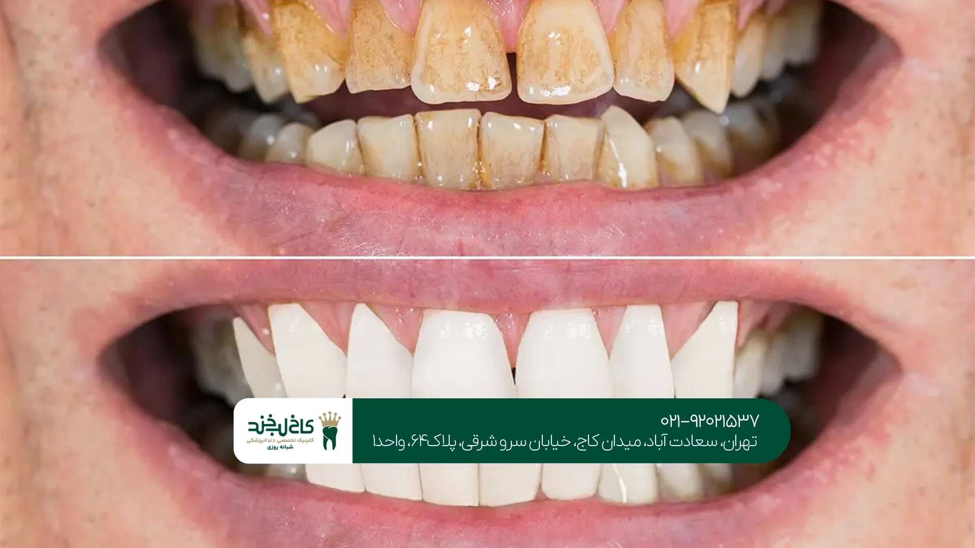 هر چند وقت یکبار باید جرمگیری دندان انجام داد؟