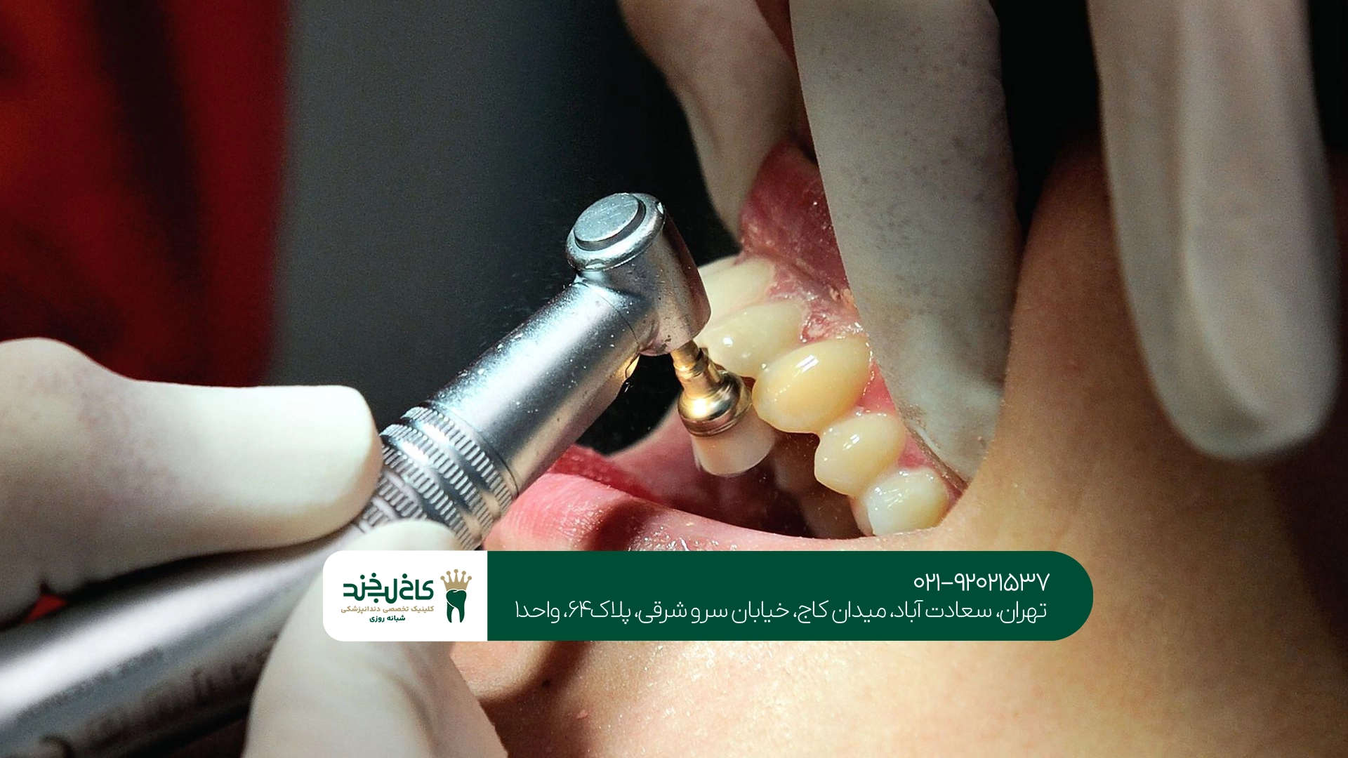 آیا بعد از جرمگیری دندان ضعیف میشود؟