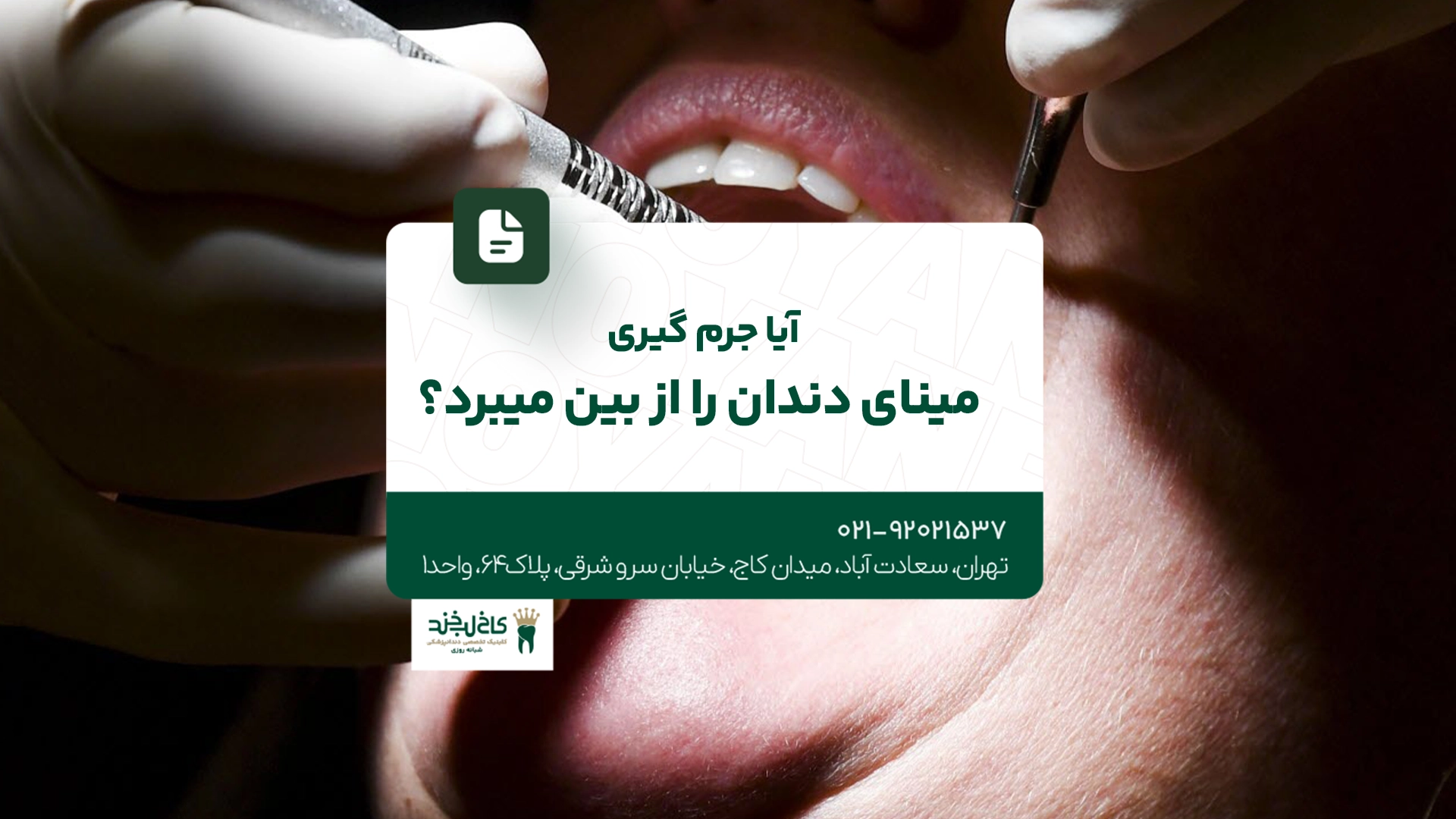 آیا جرم گیری مینای دندان را از بین می برد