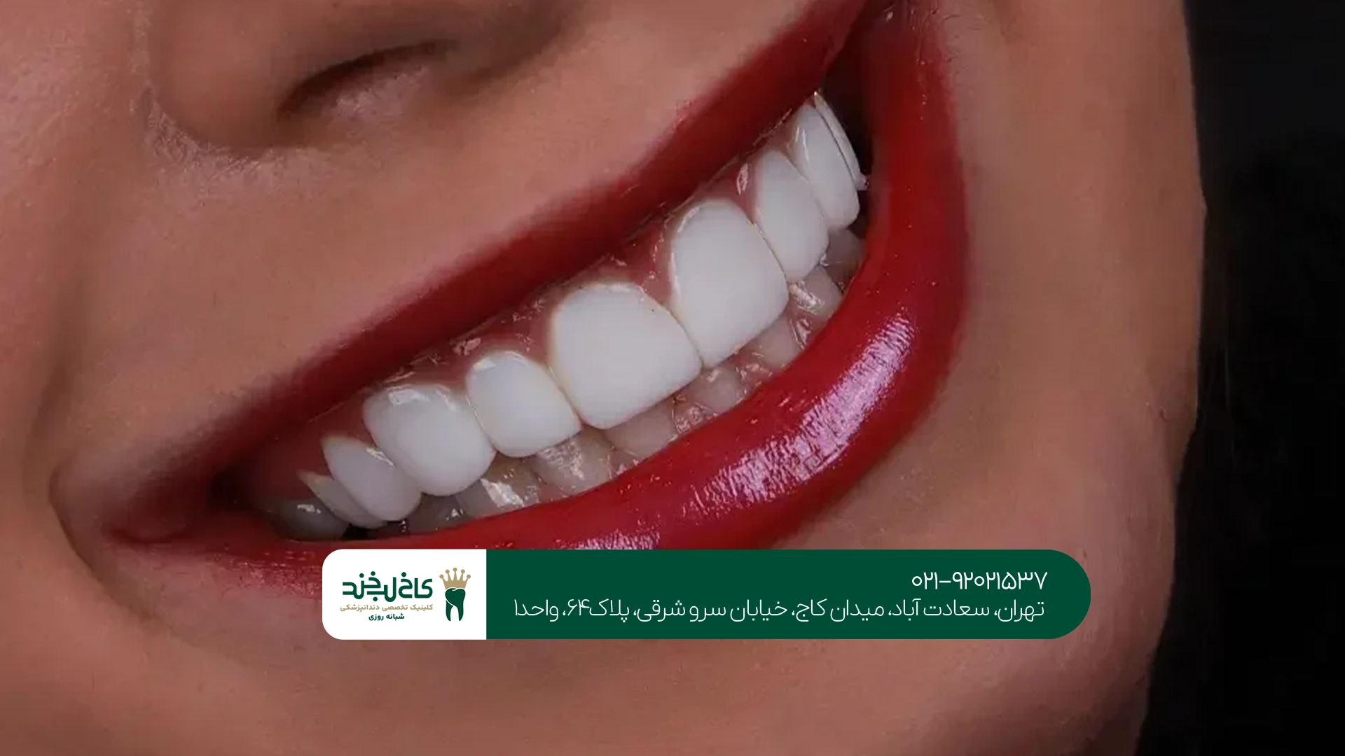 کامپوزیت دندان در بارداری