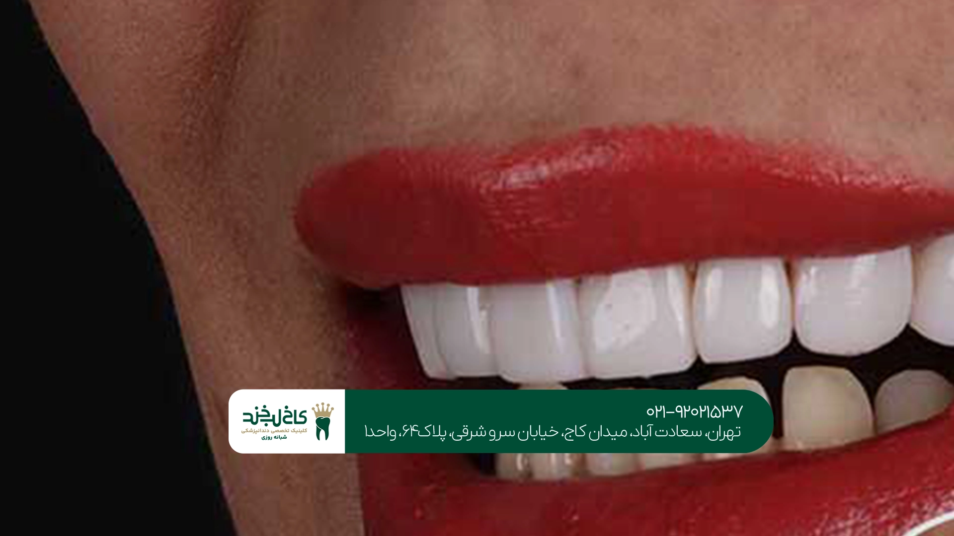 تأثیر بارداری بر سلامت دندانها و نیاز به کامپوزیت