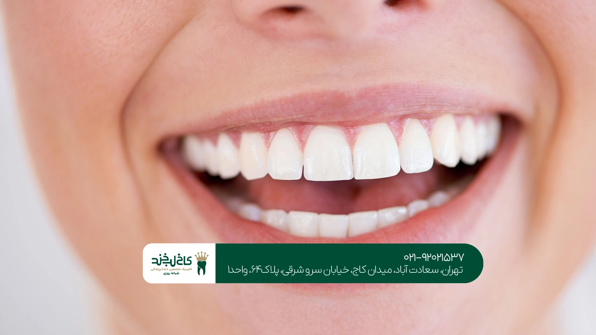 کامپوزیت دندان در تهران کامپوزیت دندان در تهران