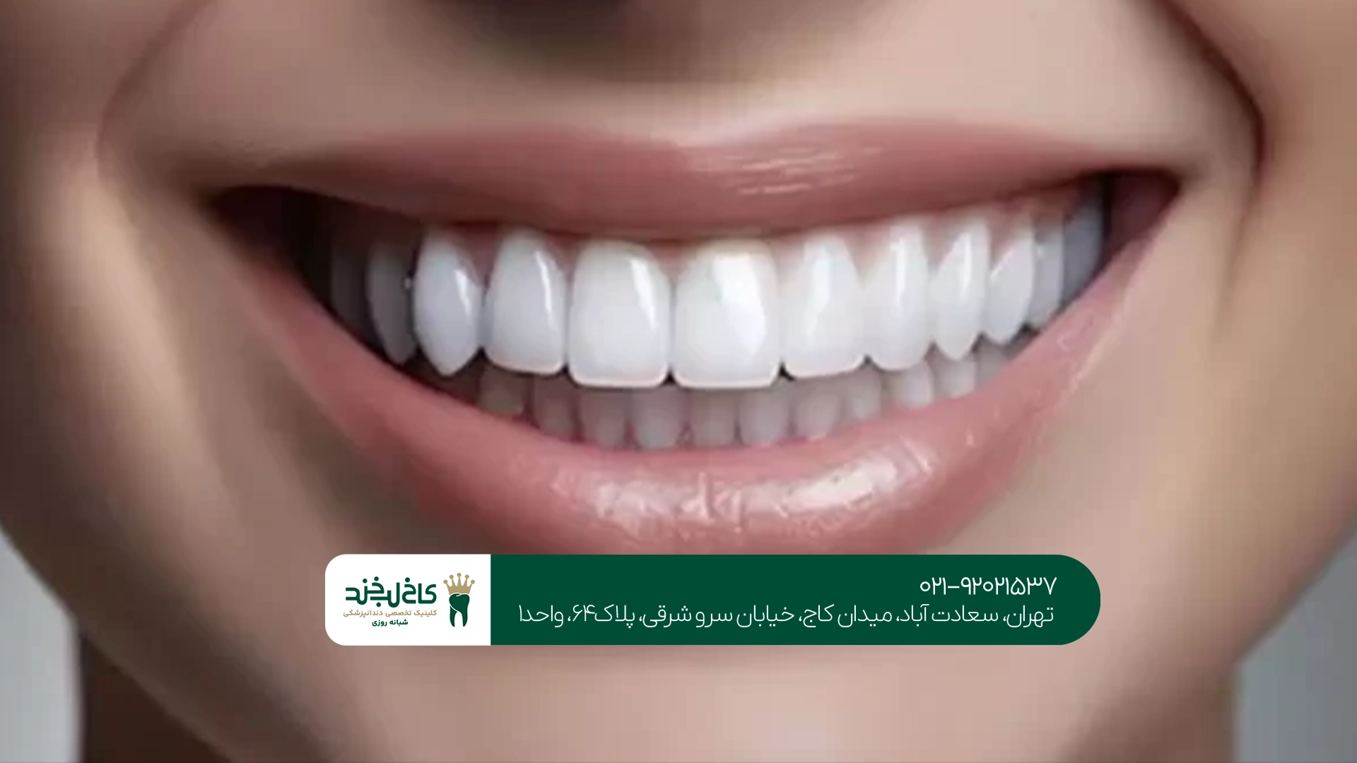 آیا کامپوزیت باعث پوسیدگی دندان می شود؟ آیا کامپوزیت باعث پوسیدگی دندان می شود؟