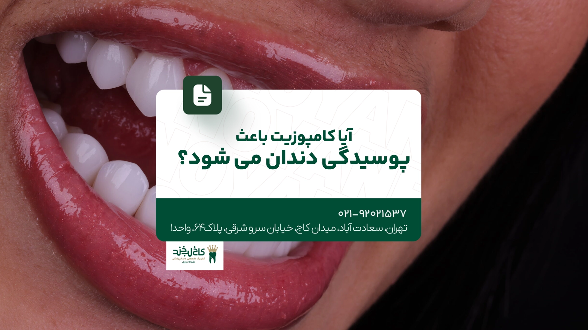 آیا کامپوزیت باعث پوسیدگی دندان می شود؟ آیا کامپوزیت باعث پوسیدگی دندان می شود؟