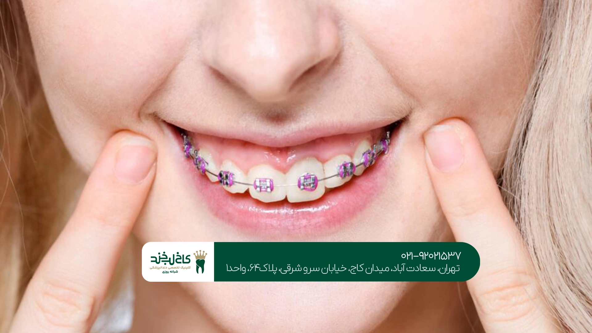 ارتودنسی دندان جلو ارتودنسی دندان جلو
