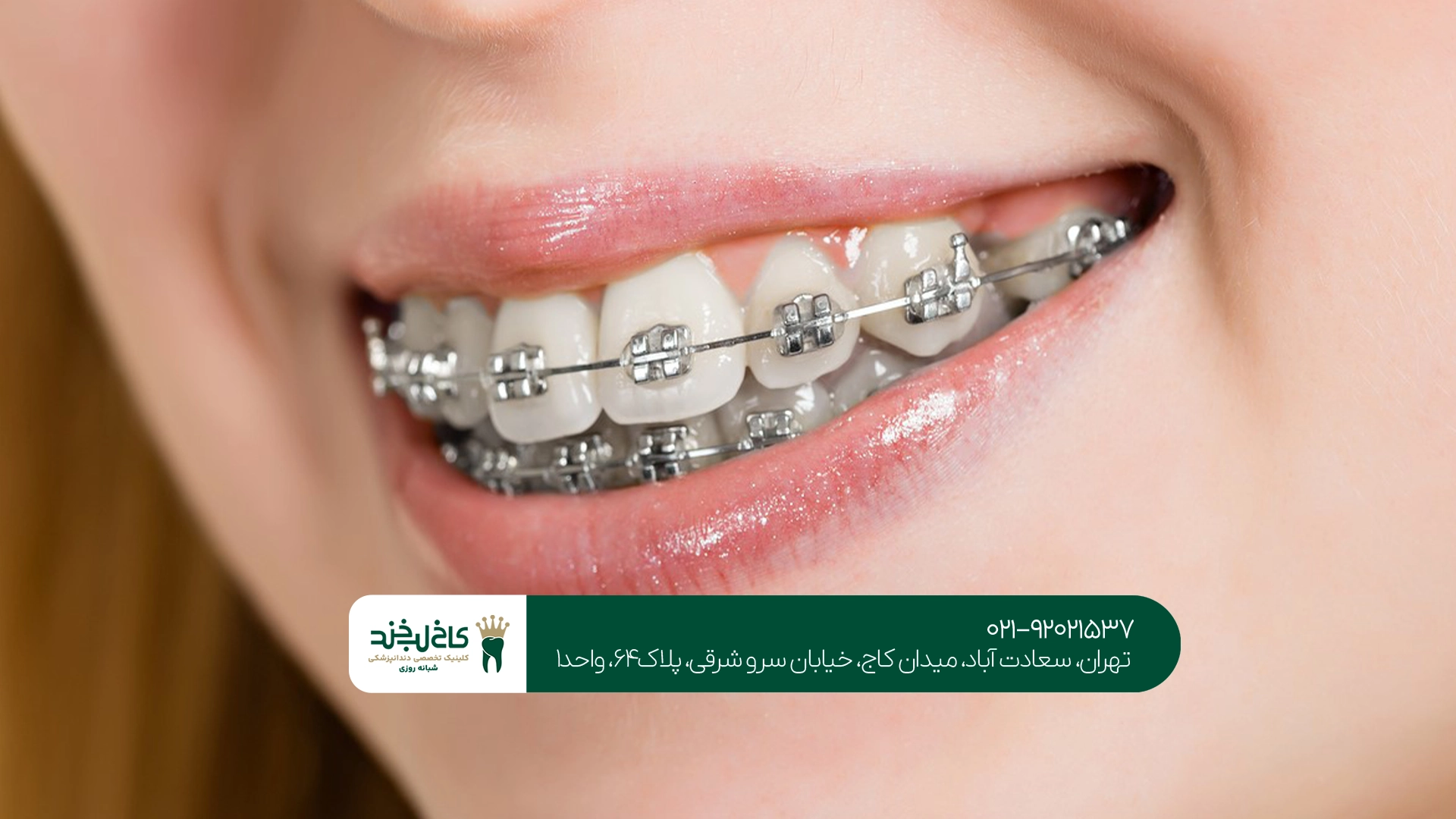 درمان ارتودنسی چقدر طول میکشد؟
