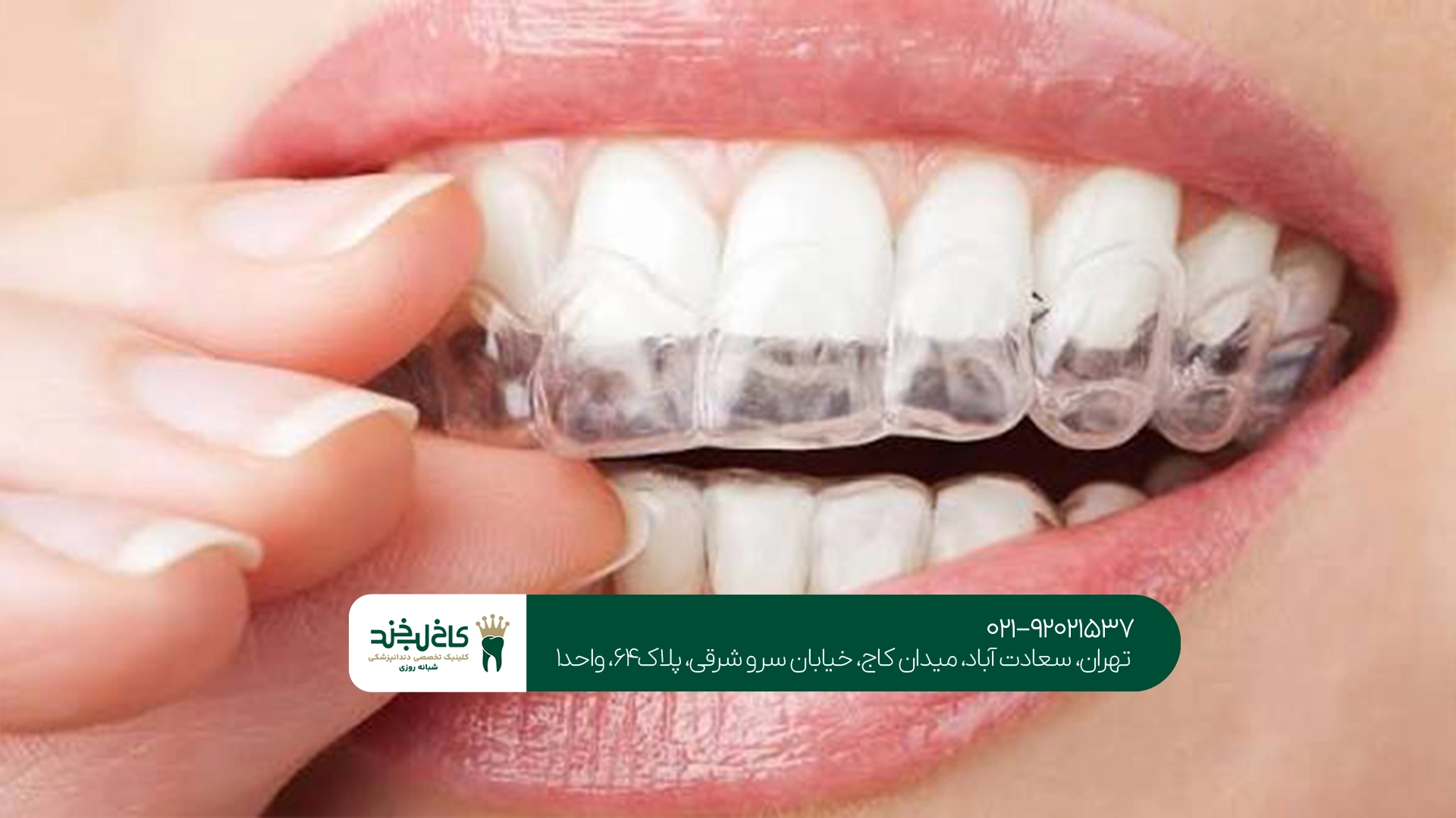 ارتودنسی نامرئی در تهران ارتودنسی نامرئی در تهران
