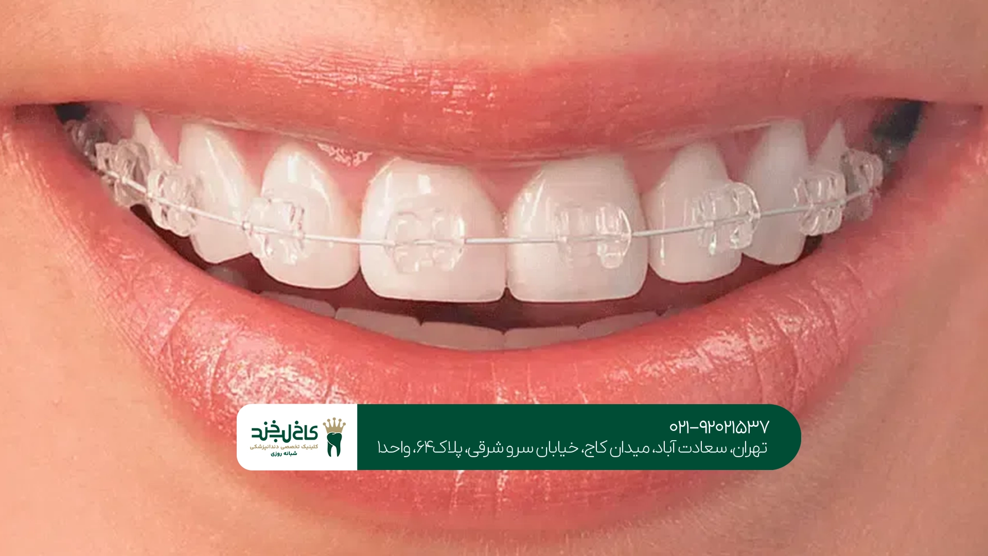 تفاوت ارتودنسی نامرئی با ارتودنسی ثابت در بزرگسالان
