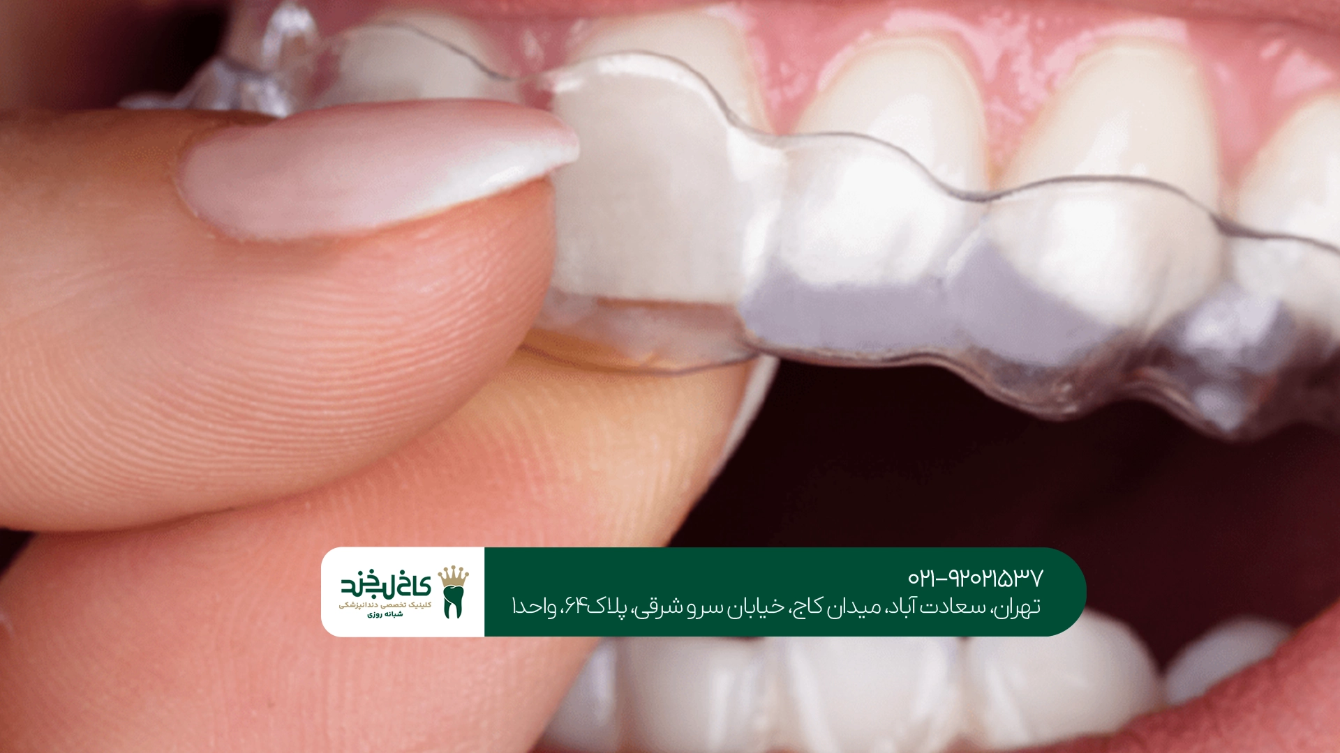 ارتودنسی نامرئی بزرگسالان با بهترین نتیجه زیبایی