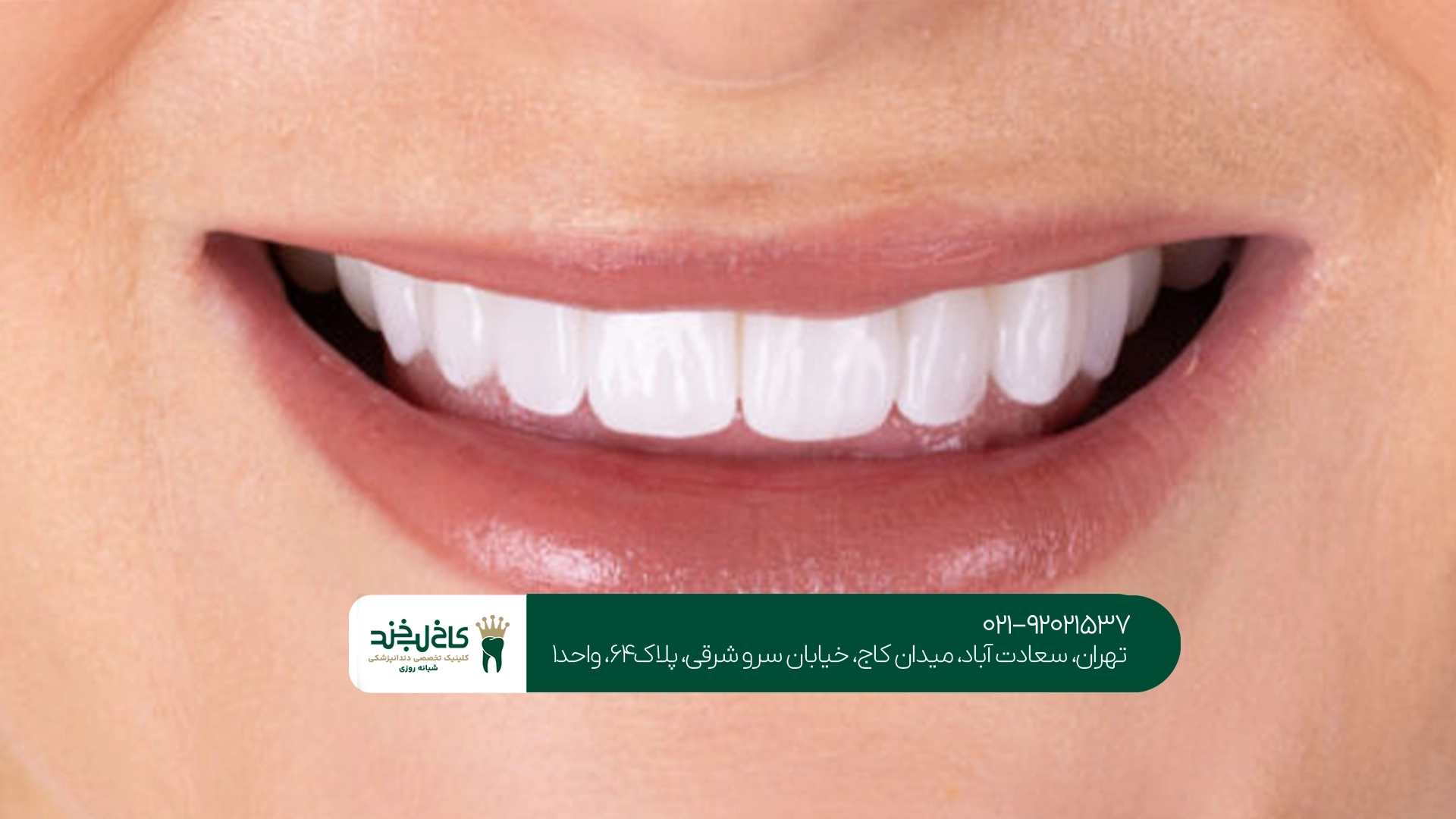 هزینه اصلاح طرح لبخند