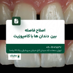 اصلاح فاصله بین دندان ها با کامپوزیت