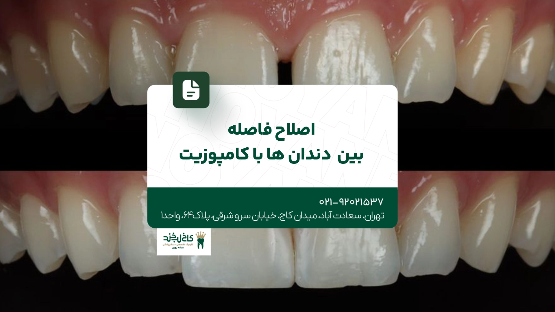 اصلاح فاصله بین دندان ها با کامپوزیت