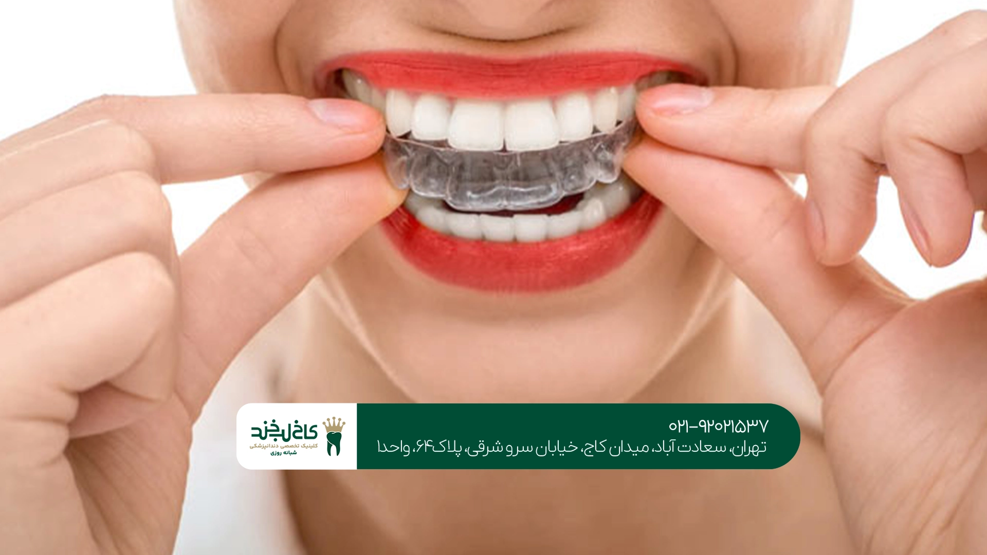 مدت زمان درمان با الاینر شفاف