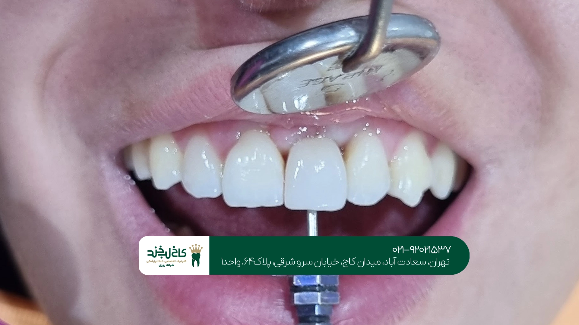 ایمپلنت بدون درد ایمپلنت بدون درد