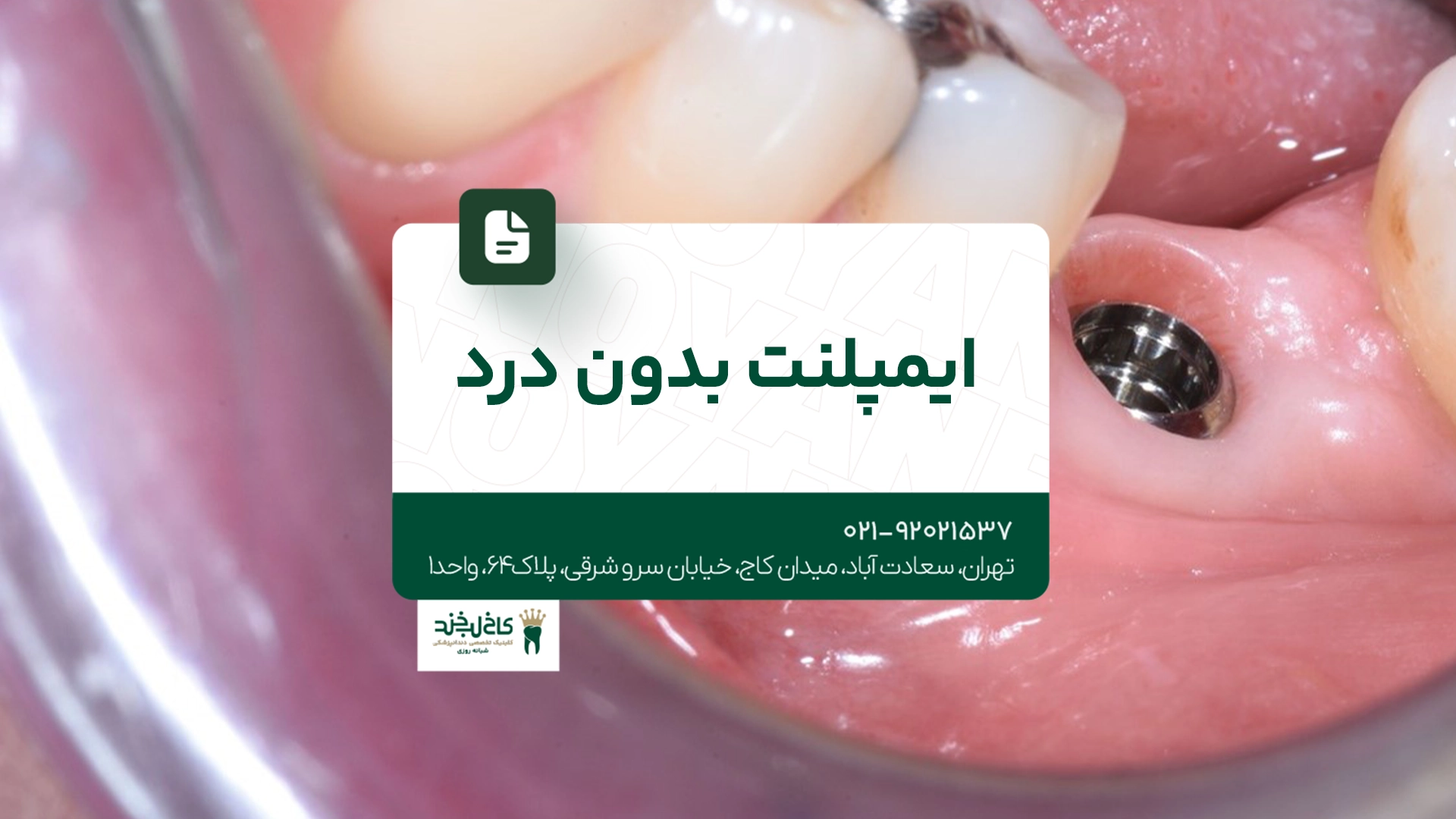 ایمپلنت بدون درد