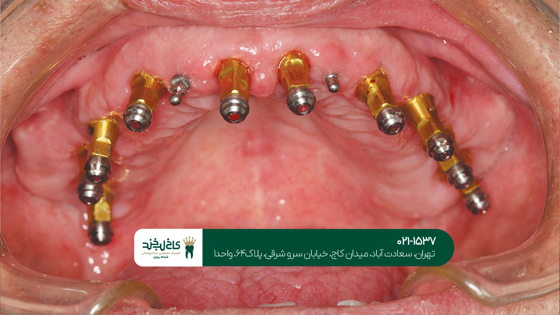 ایمپلنت تخصصی دندان