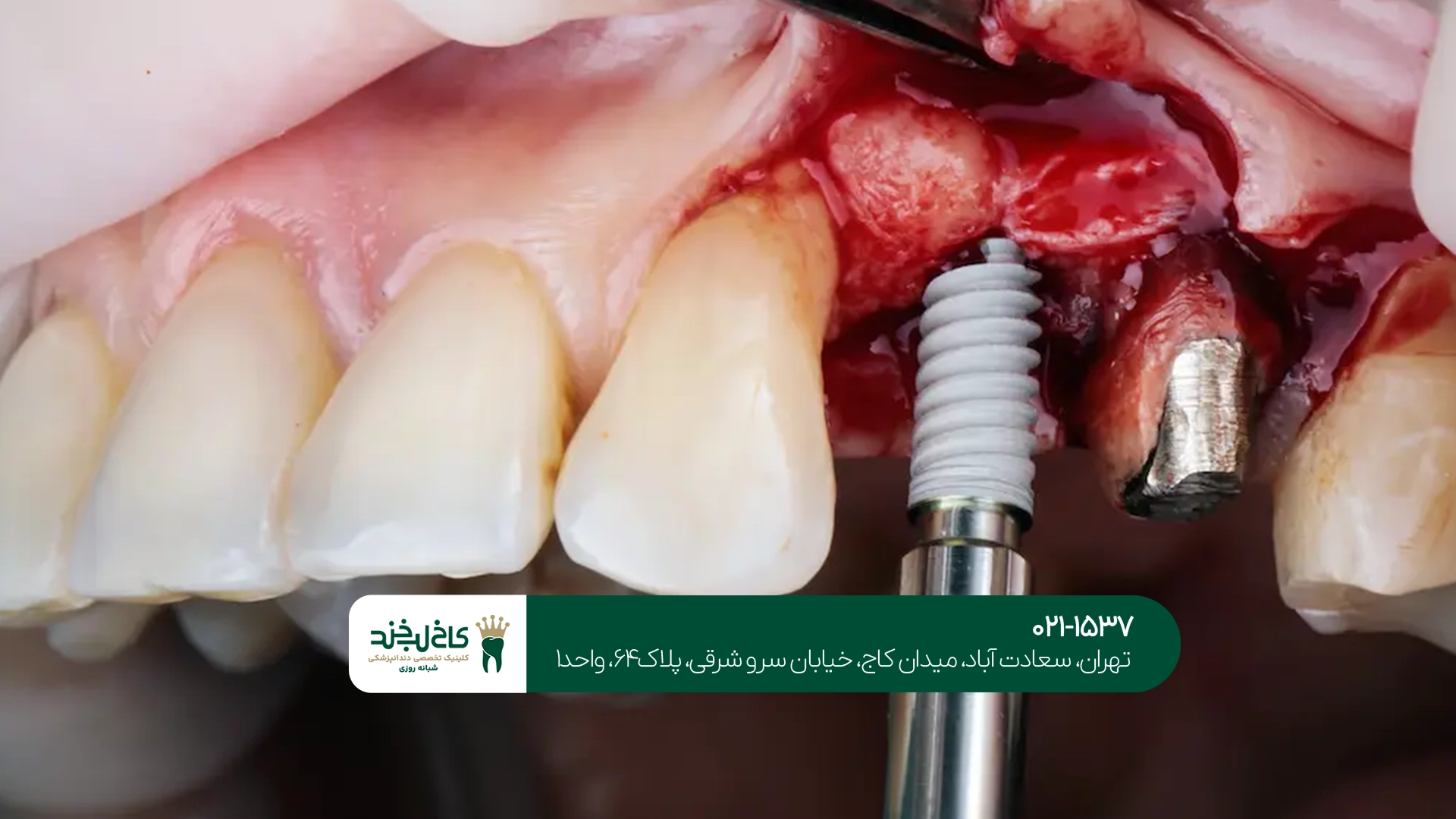 ایمپلنت تخصصی دندان