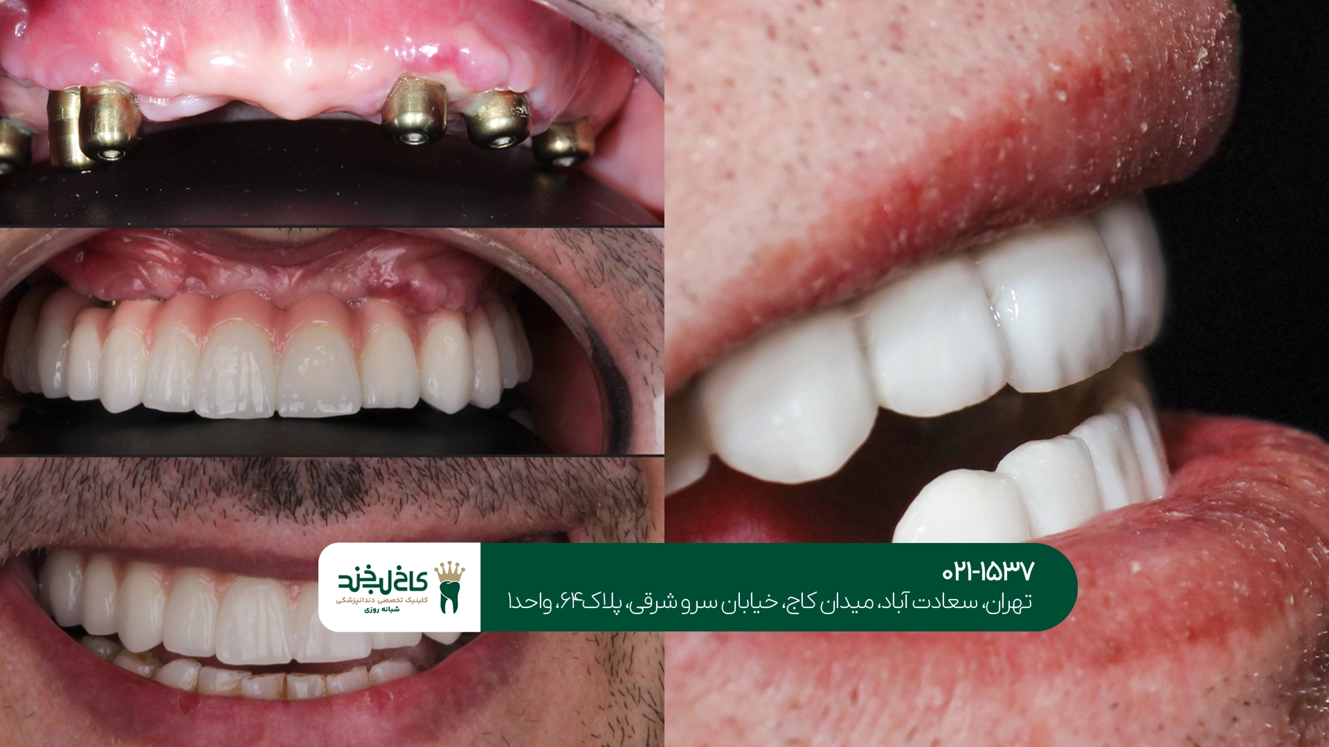ایمپلنت تخصصی دندان