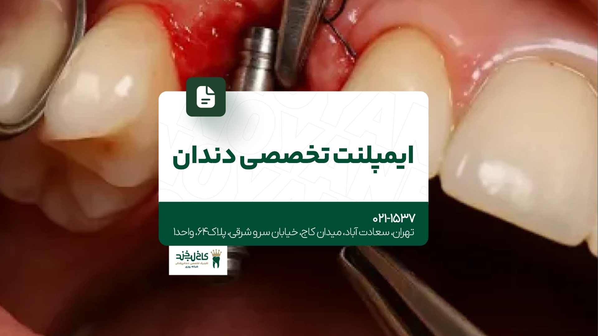ایمپلنت تخصصی دندان