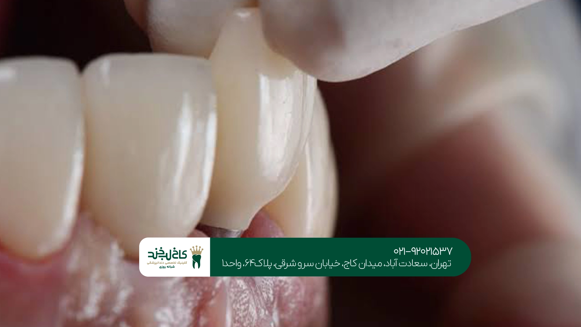 متخصص کاشت دندان تهران متخصص کاشت دندان تهران