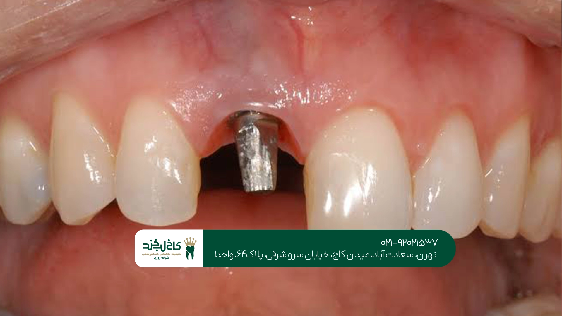 ایمپلنت دیجیتال دندان سعادت آباد ایمپلنت دیجیتال دندان سعادت آباد