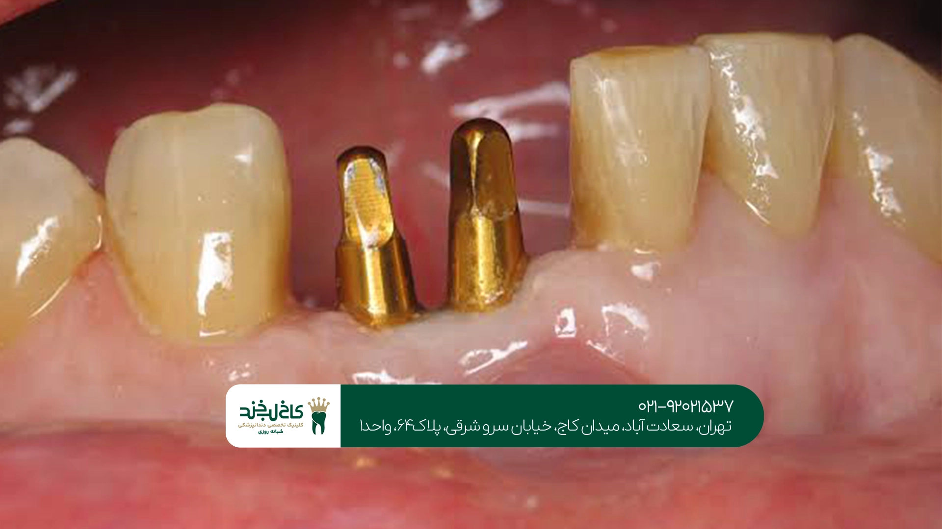 بهترین متخصص ایمپلنت دندان در سعادت آباد بهترین متخصص ایمپلنت دندان در سعادت آباد