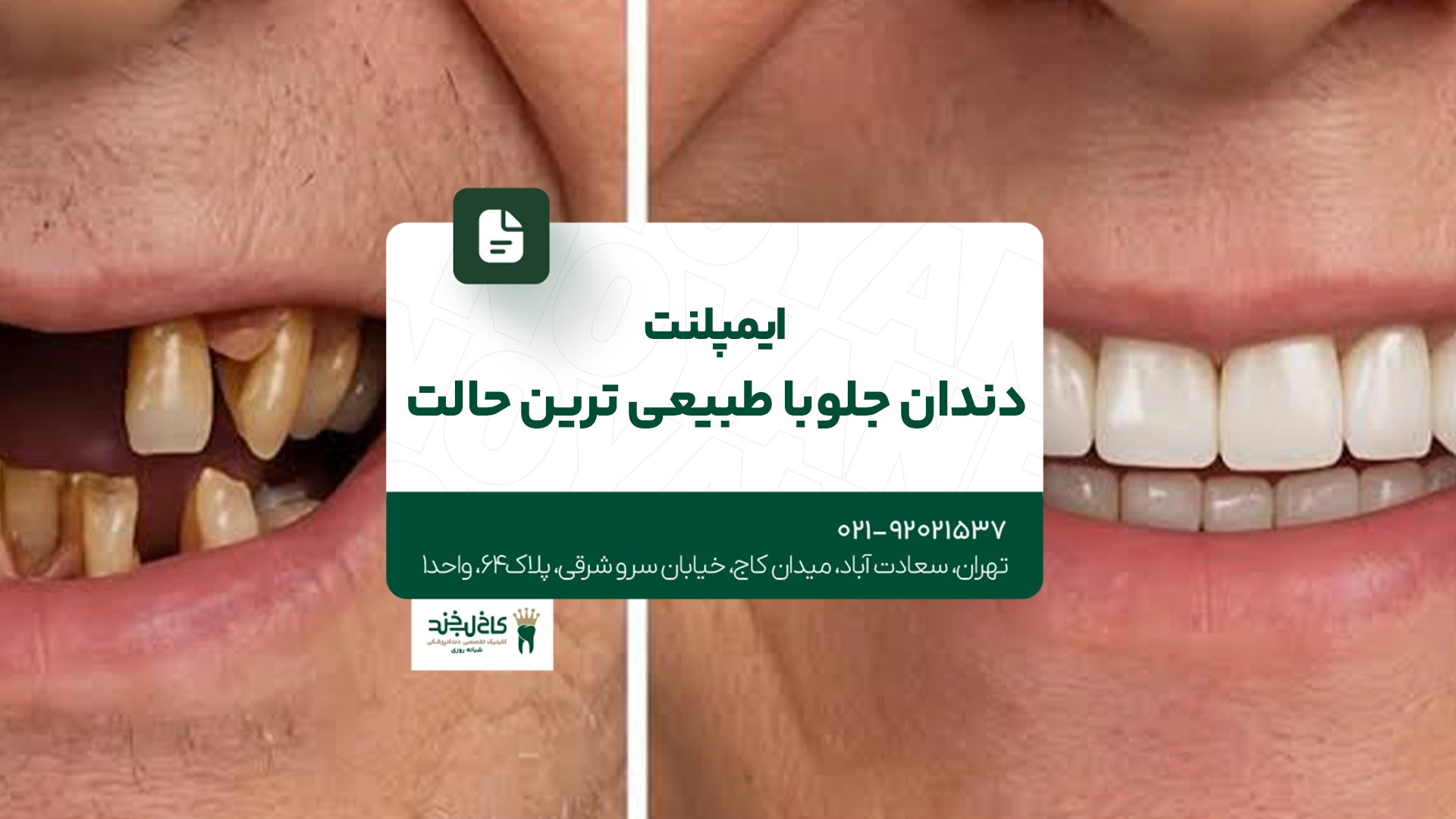 بهترین متخصص ایمپلنت دندان در سعادت آباد بهترین متخصص ایمپلنت دندان در سعادت آباد