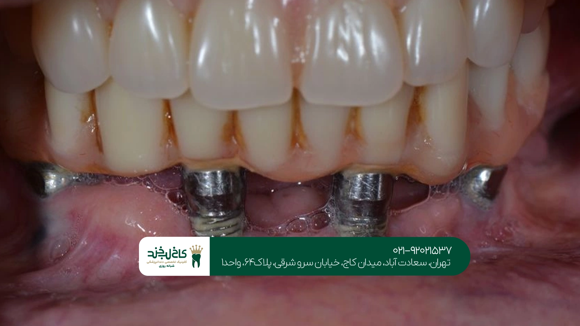 زمان جوش خوردن ایمپلنت فک پایین