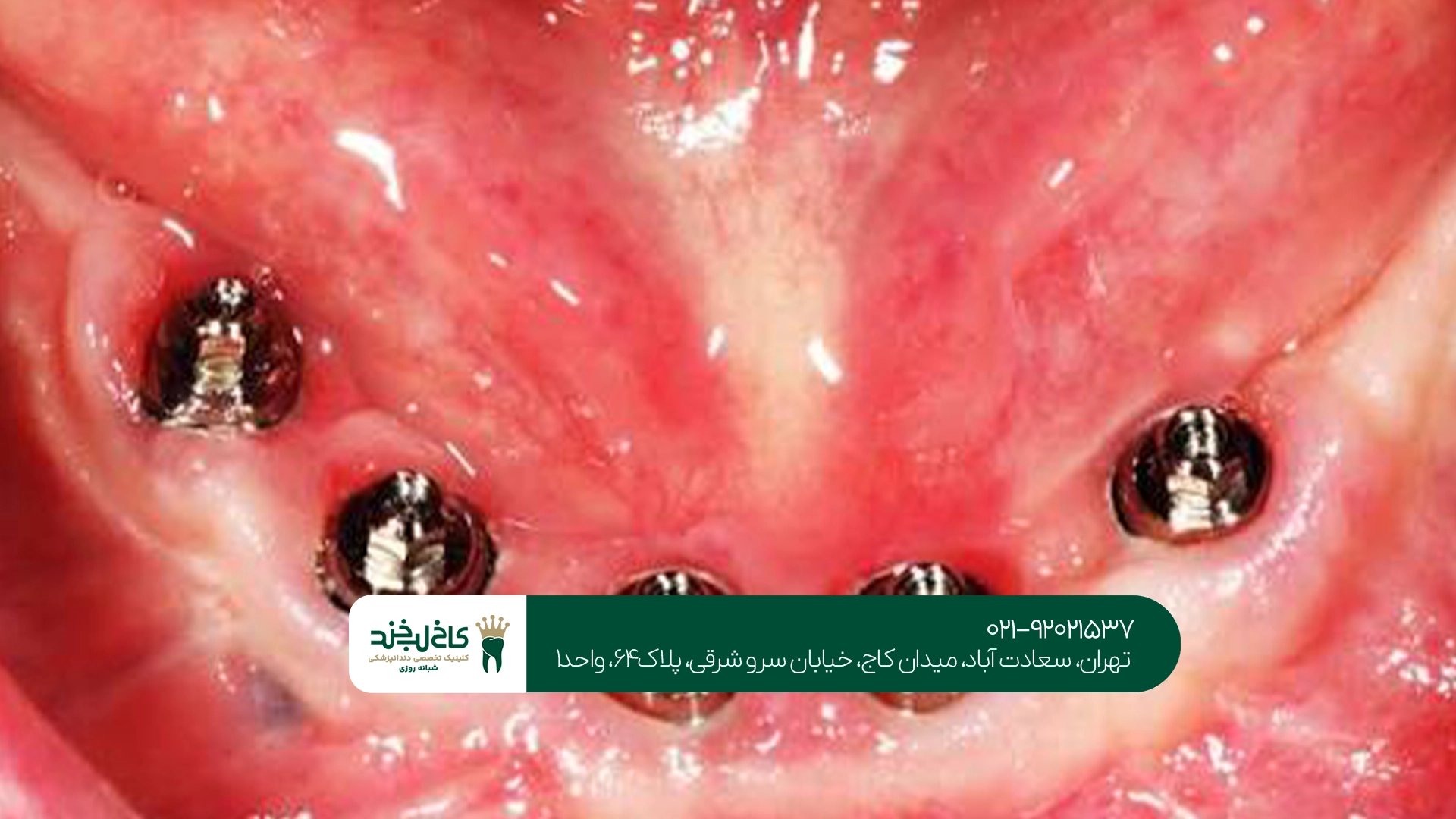 بهترین برند ایمپلنت دندان فک پایین