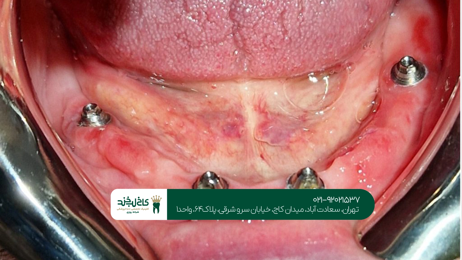 ایمپلنت فک پایین بدون جراحی