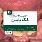 ایمپلنت دندان فک پایین