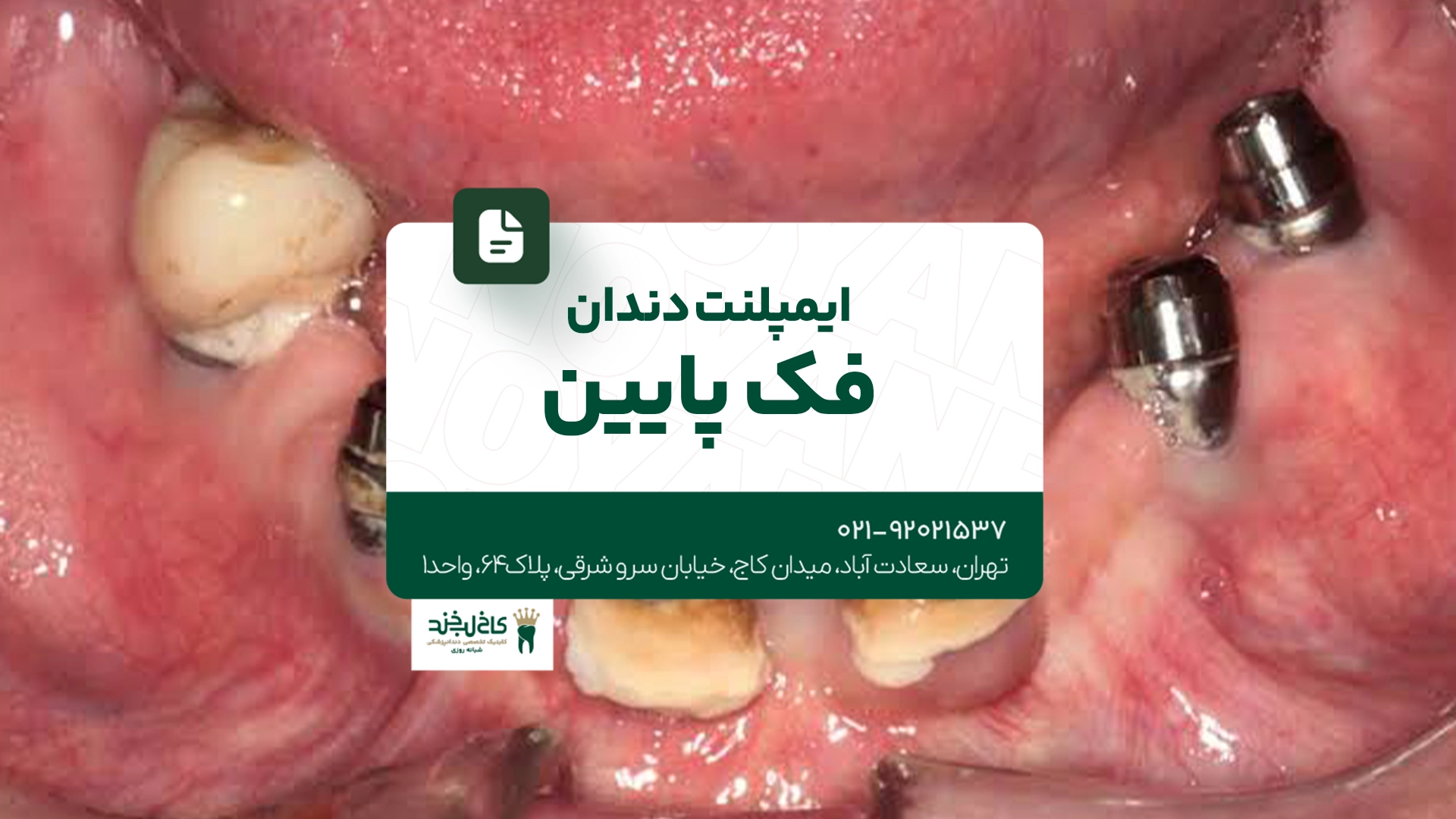 ایمپلنت دندان فک پایین