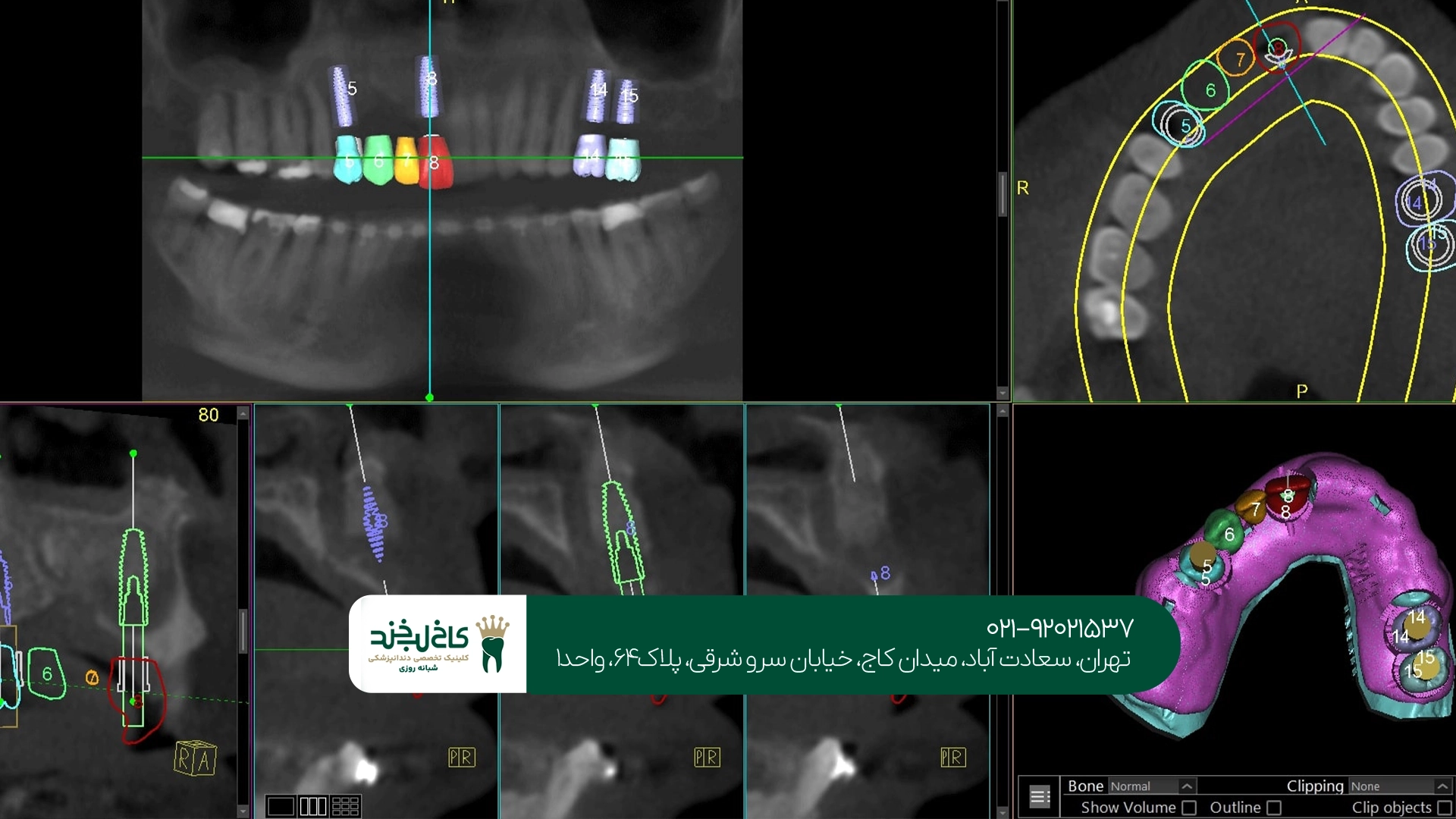 دندانپزشکی ایمپلنت دیجیتال دندانپزشکی ایمپلنت دیجیتال