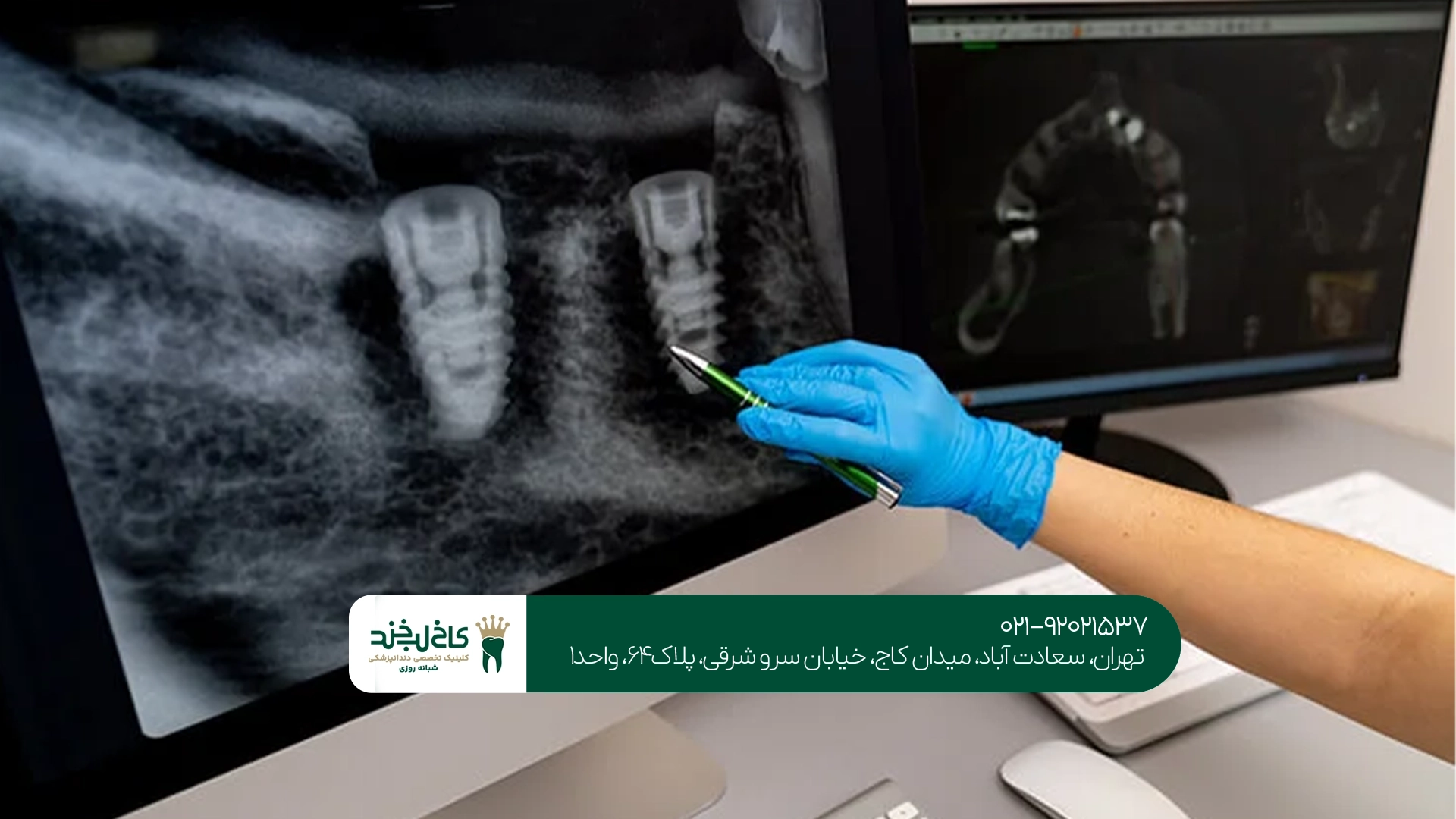 دندانپزشکی ایمپلنت دیجیتال دندانپزشکی ایمپلنت دیجیتال