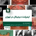 ایمپلنت دیجیتال در تهران