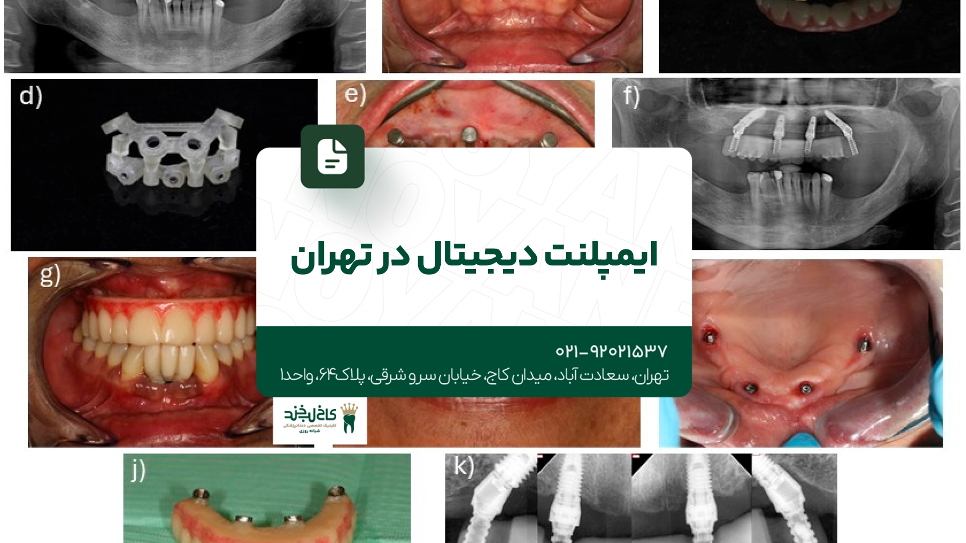 ایمپلنت دیجیتال در تهران