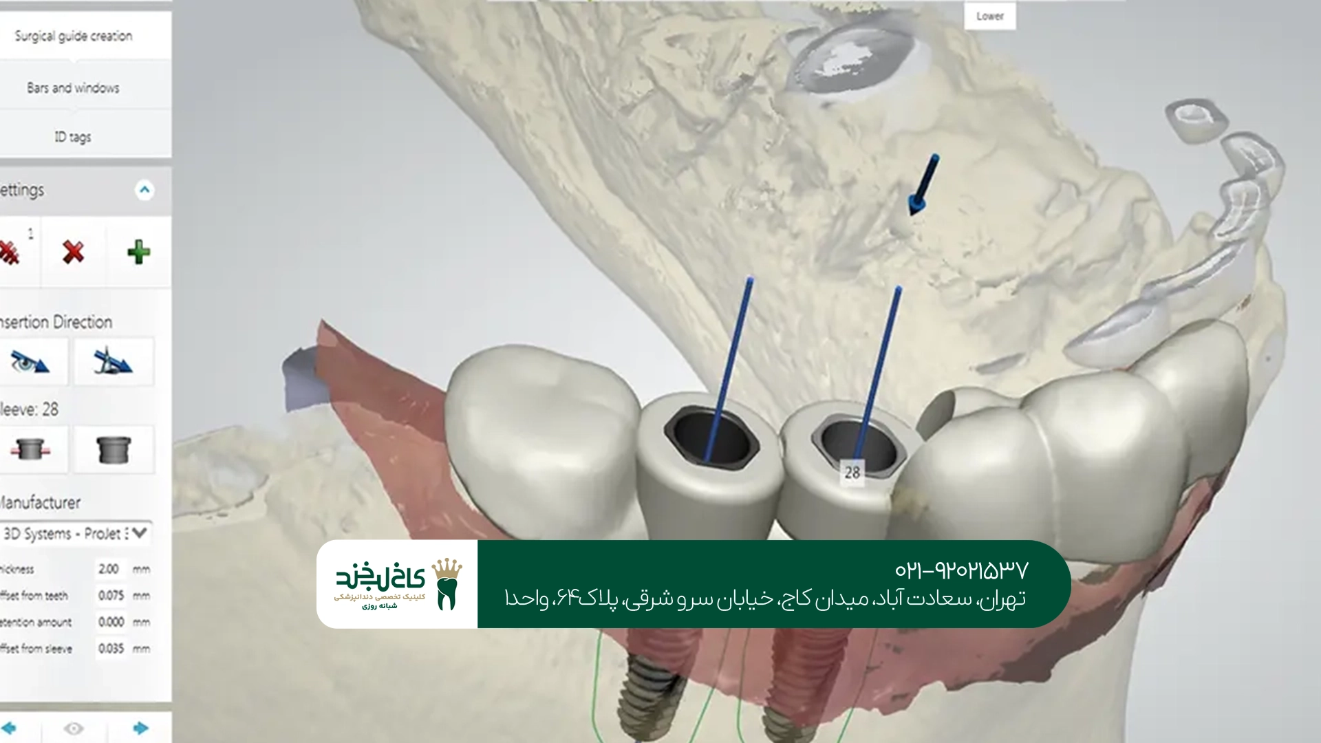ایمپلنت دیجیتال