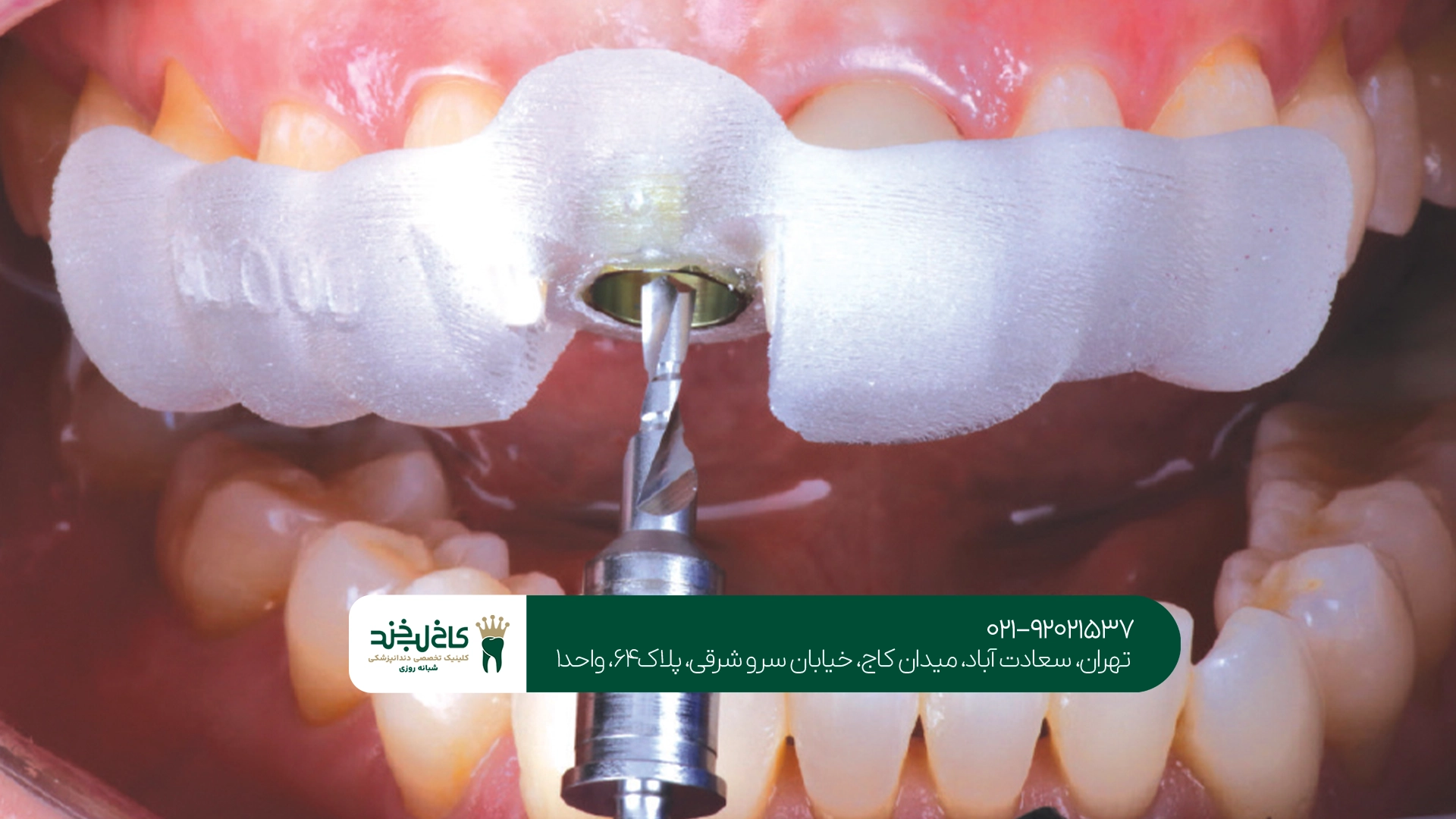 کلینیک تخصصی برای ایمپلنت فوری
