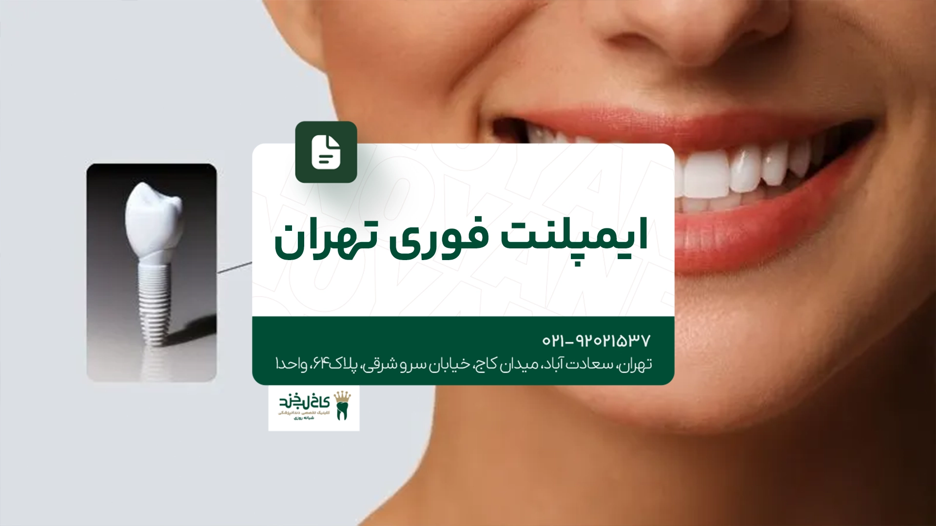 ایمپلنت فوری تهران